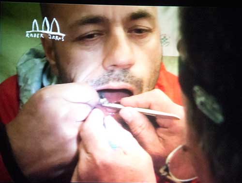 Operace zubů na Manaslu